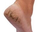 chapped heel on a white background